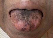 Kasus Aneh, Lidah Jadi Hitam dan Berbulu Efek Samping Obat Antibiotik