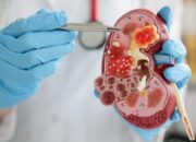 Heboh Sindikat Jual Organ, Bisa Begini Risiko Hidup dengan Satu Ginjal