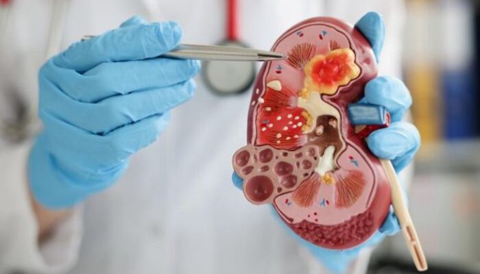 Heboh Sindikat Jual Organ, Bisa Begini Risiko Hidup dengan Satu Ginjal