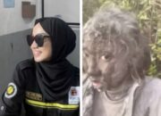 13 Hari Dirawat, Zhafirah Ife Pendaki Marapi Menghembuskan Nafas Terakhirnya