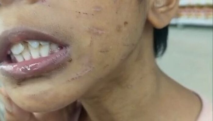 7 Fakta Memilukan Kasus Penganiayaan Bocah 9 Tahun oleh Ibu Tiri di Sagulung Batam